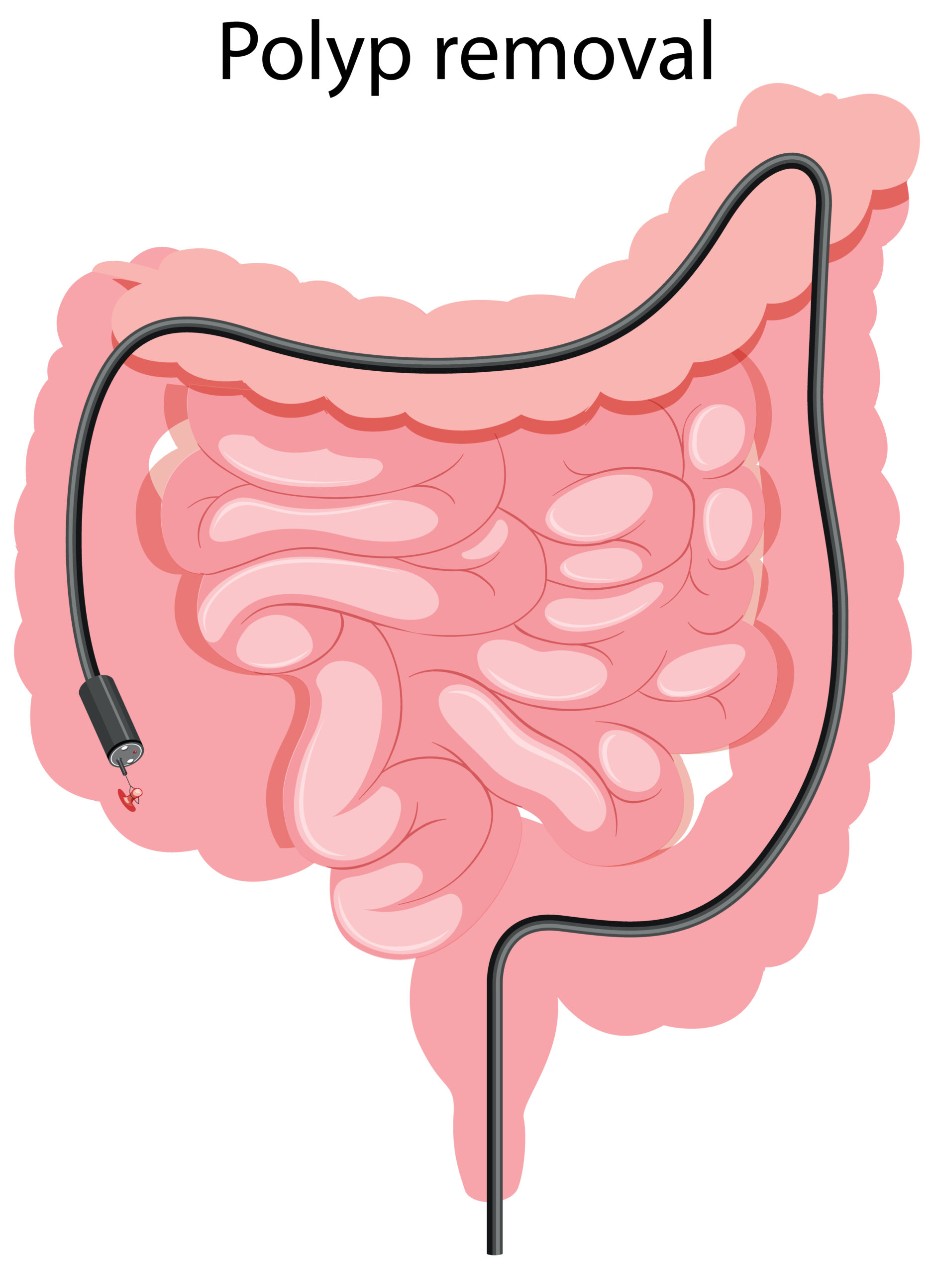 Expert Polypectomy in Aurangabad | Dr. Ashish R. Gandhi